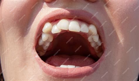 Premium Photo Curved Female Teeth Before Installing Braces Close