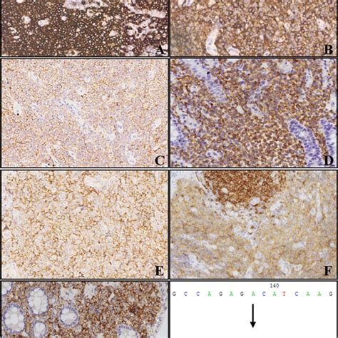 Immunohistochemical And Molecular Pathological Findings Of The Patient