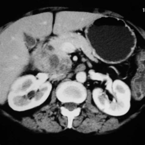 Cect Abdomen Showing Peripancreatic Lymph Nodes With Central Necrosis