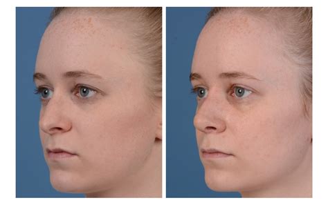 Before And After Gallery Dr Bardia Amirlak Rhinoplasty Website