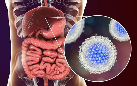 Hepatitis C Gejala Penyebab Pengobatan Dan Pencegahan