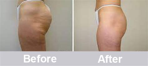 Velashape Machine For Cellulite Body Contouring PrettyLasers