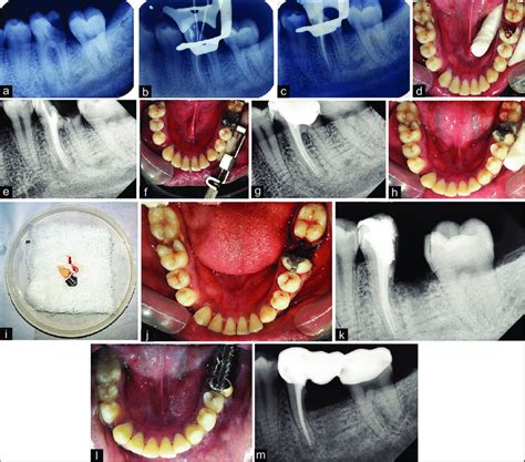 A Preoperative Intraoral Periapical Radiographs B Working Length