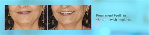 Full Mouth Dental Implants Dixitdentaldemo