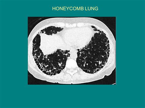 Claps Lung Collapsed Lung Pneumothorax Symptoms Causes And Treatment