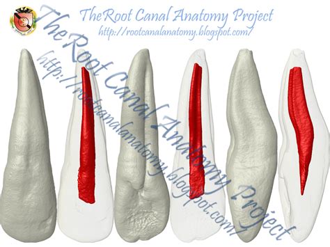 The Root Canal Anatomy Project Radicular Groove Maxillary Incisors