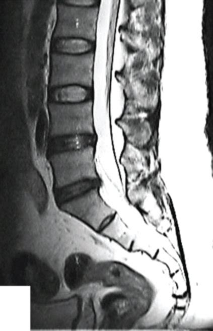 Radiographic Data Of The Typical Case A 51 Year Old Male Patient Was