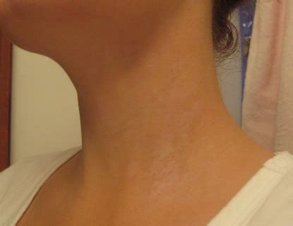 Mild Eczema on Neck - Eczema Free Skin