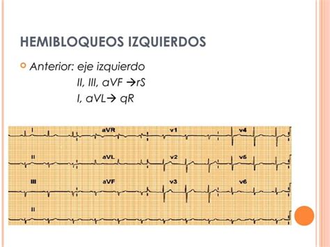 Electrocardiograma Ecg B Sico Ppt