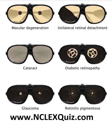 Types of Vision Loss Cheat Sheet - NCLEX Quiz