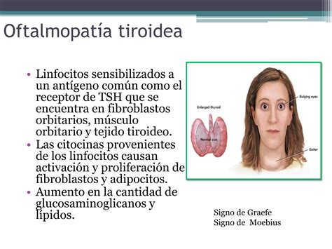 Hipertiroidismo Enfermedad De Graves Basedow Perry Ppt