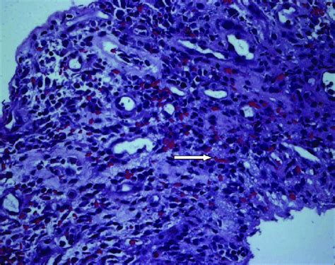 Histology of the sigmoid colon showing granulation tissue and base... | Download Scientific Diagram