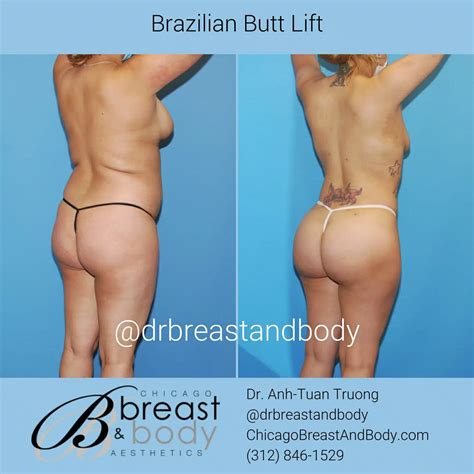 Brazilian Butt Lift Cost Copia Chicago Breast Body Aesthetics