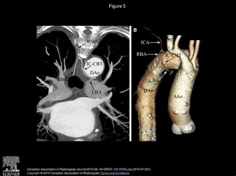 The Normal Anatomy And Variations Of The Bronchial Arteries Evaluation