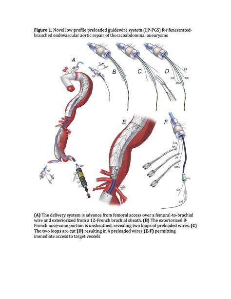 Scvs Endovascular Repair Of Thoracoabdominal Aneurysms Using A Novel Low Profile Multibranched