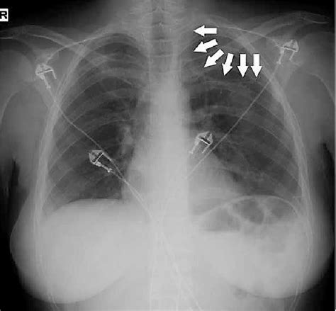 The Patient S Chest X Ray Was Obtained In The Recovery Room After