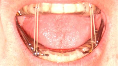 Mandibular Advancement Splint