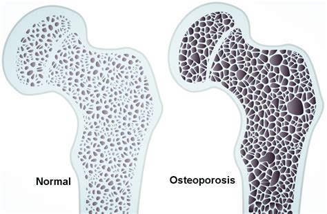 Osteopenia Osteoporosis Reumatología Rosario