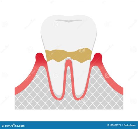 The Stages of Periodontitis Disease Illustration / Mild Periodontitis Stock Vector ...