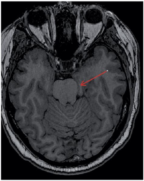 Figure 1 from Herniation of uncus and parahippocampal gyrus: an ...