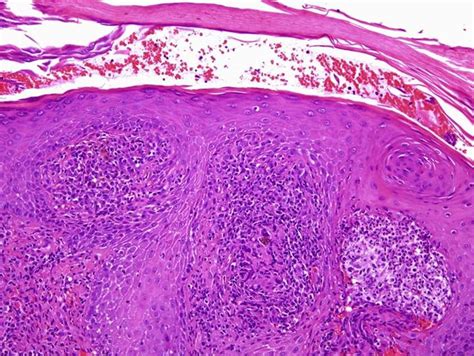 Pseudoepitheliomatous Hyperplasia And Presence Of Pigmented Spores