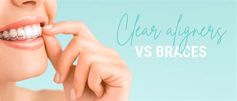 Choosing Between Clear Aligners And Braces Ez Smile