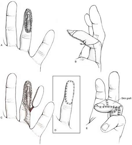 Homodigital Island Flap Musculoskeletal Key