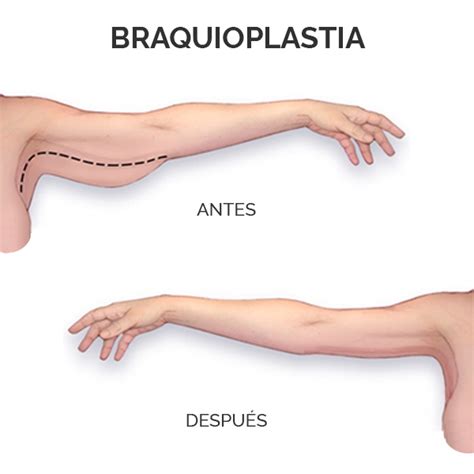 Recupera La Firmeza De Tus Brazos Con Braquioplastia