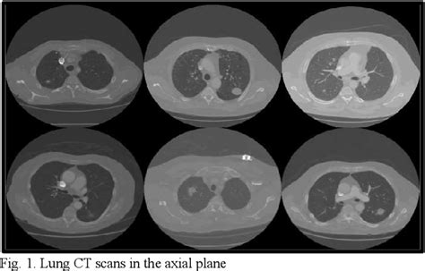 Figure 1 From Lung Nodule Segmentation And Classification Using Conv