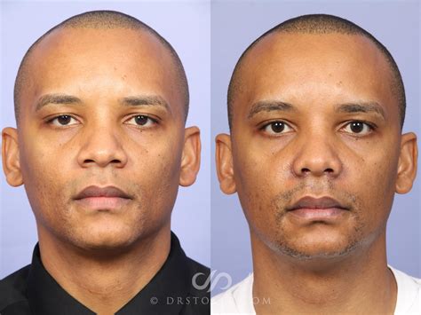 Rhinoplasty Before And After Male Debora Bull