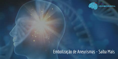 Emboliza O De Aneurismas Saiba Mais Dr Victor Barboza Neurocirurgia