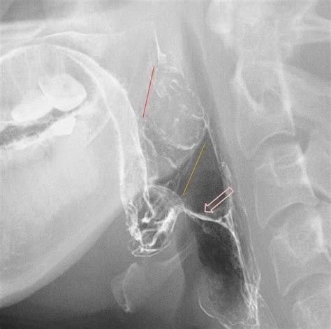 Normal barium swallow (lateral view) | Radiology Case | Radiopaedia.org