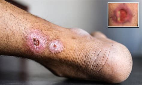 Urgent Warning As A Horrific Flesh Eating Tropical Disease Spreads