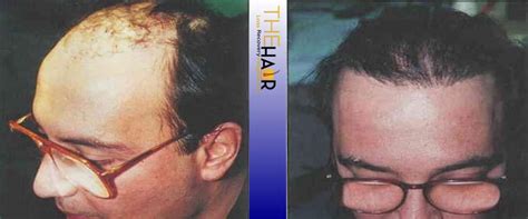 Gallery Hair Loss Recovery By Dr Larry Fremont