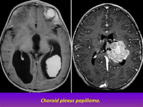 Presentation1pptx Radiological Imaging Of Hydrocephalus Ppt