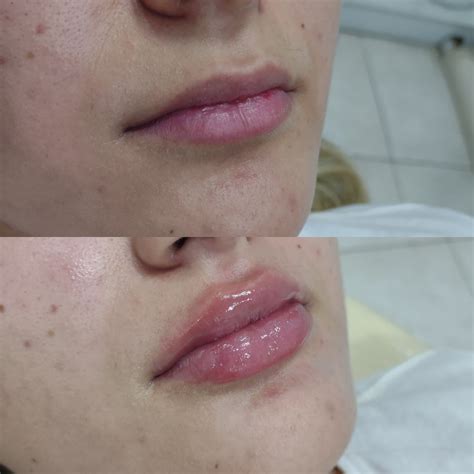 Preenchimento Labial DR Igor Ramos