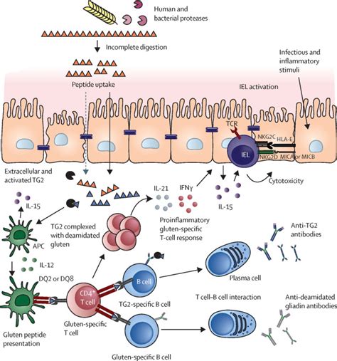 Coeliac Disease The Lancet