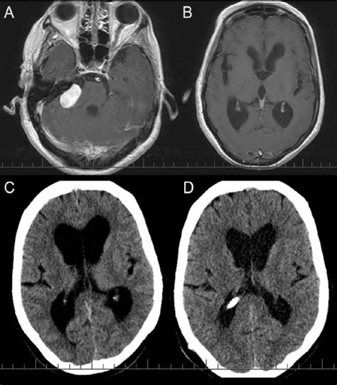 Case No 3 A Preoperative Axial T1 Weighted Magnetic Resonance