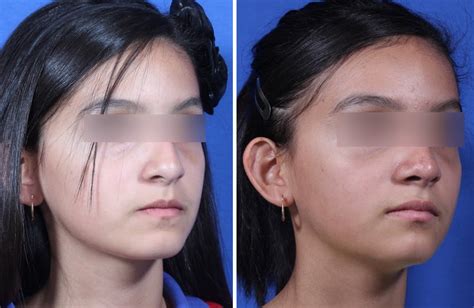 Rhinoplasty Austin Tx Dr Weinfeld