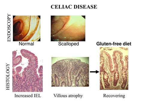 Endoscopy In Celiac Disease At Conrad Hughes Blog