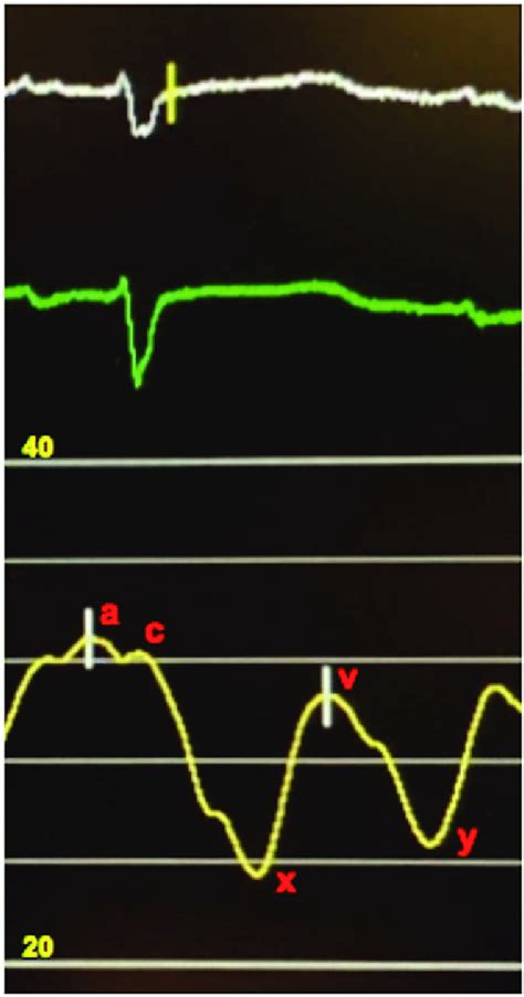 Right atrial pressure trace showing elevated mean right atrial pressure... | Download Scientific ...