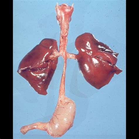 Esophageal Atresia Pediatric Radiology Reference Article Pediatric