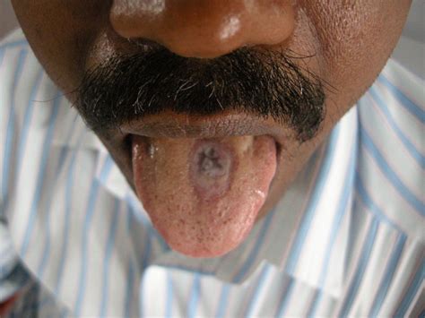 Atypical Histiocytic Granuloma Of Tongue Bmj Case Reports