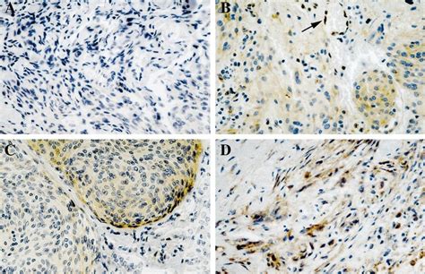 Immunohistochemical Localization Of Sparc In Meningiomas Of All Grades