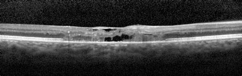 Idiopathic Juxtafoveal Retinal Telangiectasis