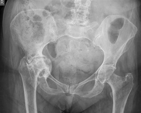 Protrusio acetabuli also known as acetabular protrusion - is ...