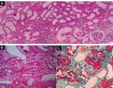 Medial vasculopathy in a case of Barakat syndrome. (A) (H and E, ×100):... | Download Scientific ...