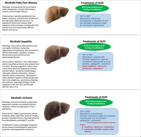 Treatment of Alcohol Use Disorder in Patients with Alcoholic Liver ...