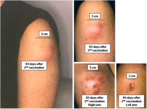 Case Report Of Local Reaction And Sterile Abscess Forma Openi