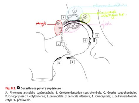 S Ue Rhumato Arthrose Cartes Quizlet